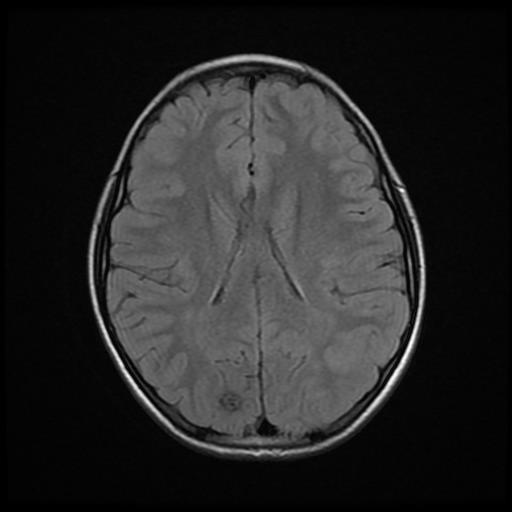 Cavernoma - occipital | Image | Radiopaedia.org