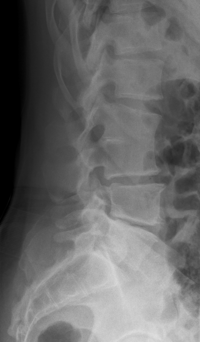 Block vertebra | Image | Radiopaedia.org