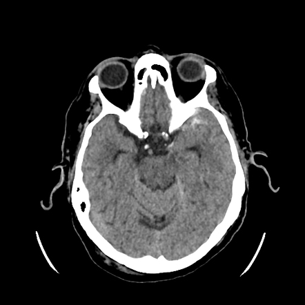 Coup-contrecoup Injury Pattern In Acute Head Trauma | Radiology Case ...