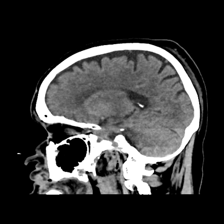 Coup-contrecoup injury pattern in acute head trauma | Image ...