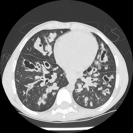 Cystic fibrosis | Radiology Case | Radiopaedia.org