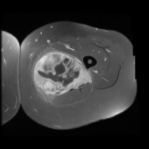 Myxoid Liposarcoma 