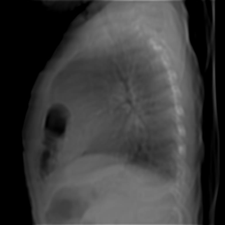 Morgagni Hernia Image