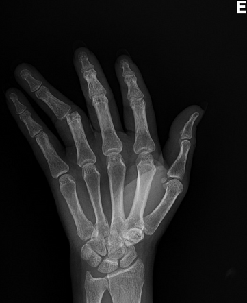 Proximal interphalangeal joint dislocation - 4th finger | Image ...