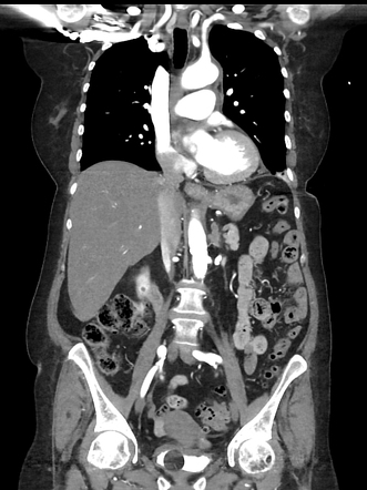 Aortic Intramural Hematoma | Image | Radiopaedia.org