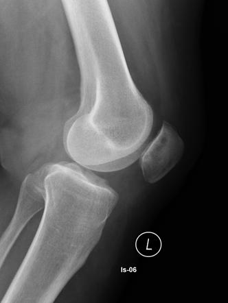 Chondromalacia deals of patella