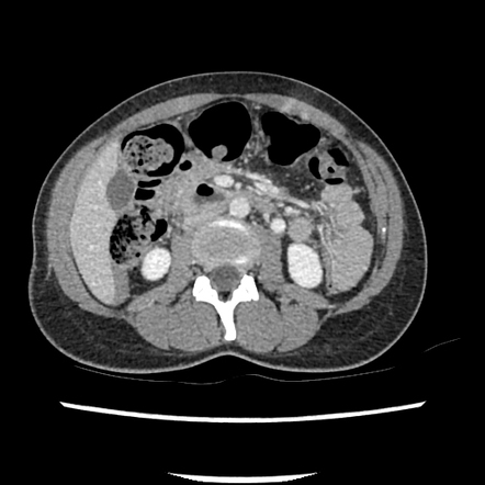 Ruptured corpus luteum cyst with hemoperitoneum | Radiology Case ...