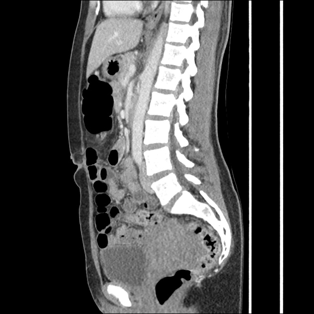 Ruptured corpus luteum cyst with hemoperitoneum | Image | Radiopaedia.org