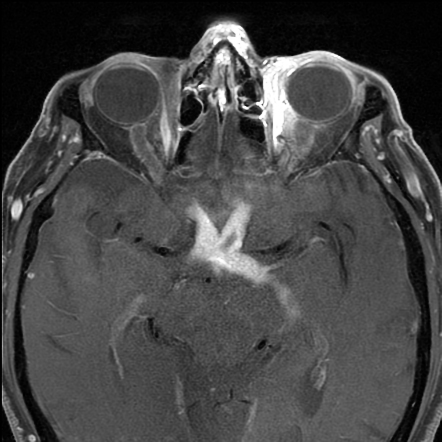 Optic pathway glioblastoma | Radiology Case | Radiopaedia.org