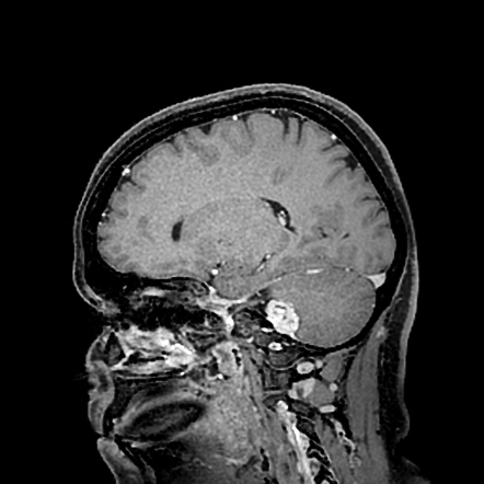 Cerebellopontine angle meningioma | Image | Radiopaedia.org