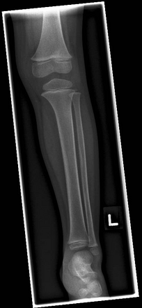 Normal pediatric tibia fibula series | Radiology Case | Radiopaedia.org