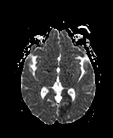 Posterior cerebral artery (PCA) infarct | Image | Radiopaedia.org