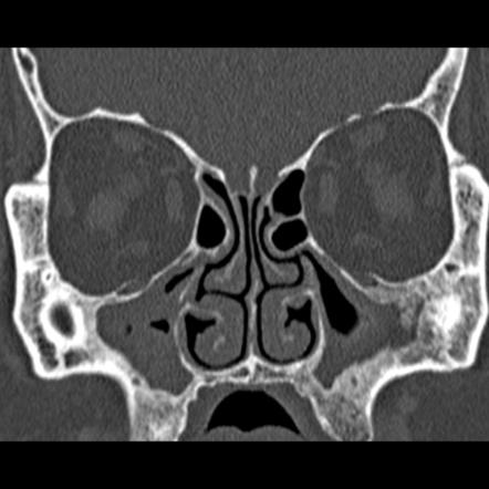 Chronic maxillary sinusitis | Radiology Case | Radiopaedia.org