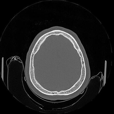 Atlanto-occipital Assimilation With Cleft Of The Posterior Arch Of C1 