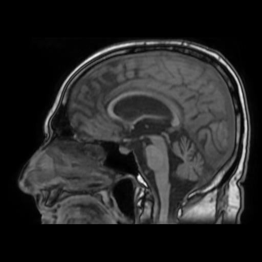 Normal Pressure Hydrocephalus Image