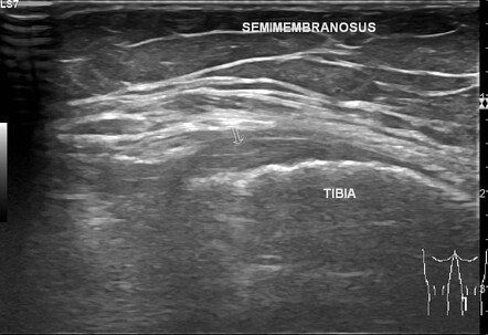 Gracilis injury | Image | Radiopaedia.org