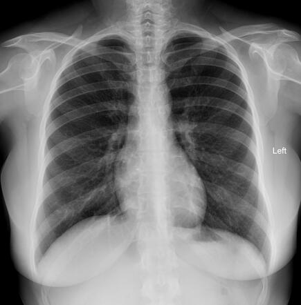 Atrial septal defect occlusion device | Image | Radiopaedia.org