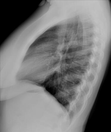 Atrial septal defect occlusion device | Radiology Case | Radiopaedia.org