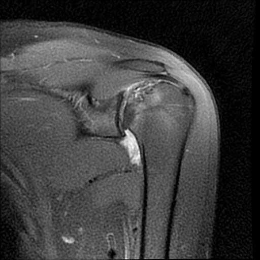 Osteonecrosis of the humeral head | Image | Radiopaedia.org