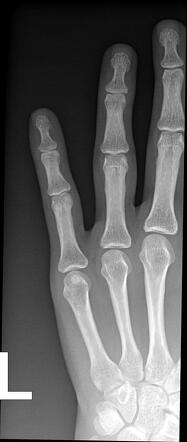 Mallet finger | Radiology Case | Radiopaedia.org