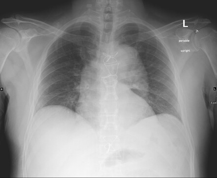 Renal infarction - a secondary cause due to aortic dissection ...