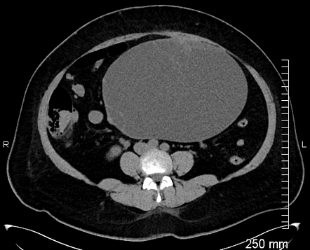 Ovarian mucinous cystadenofibroma | Radiology Case | Radiopaedia.org