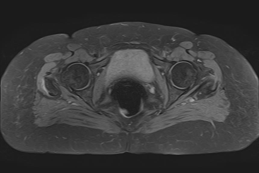 Trochanteric Bursitis | Image | Radiopaedia.org