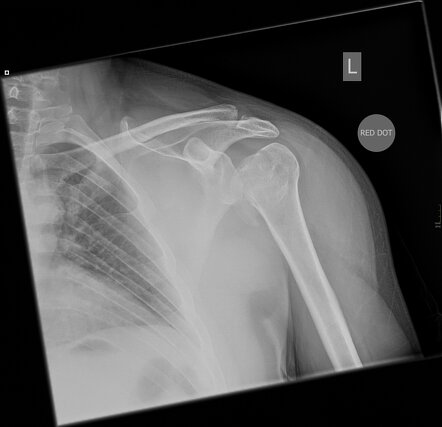 Bilateral Posterior Shoulder Fracture Dislocation Due To Electrocution 