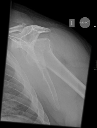 Bilateral posterior shoulder fracture dislocation due to electrocution ...