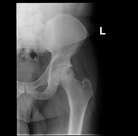 Avascular necrosis of the hip - bilateral | Image | Radiopaedia.org