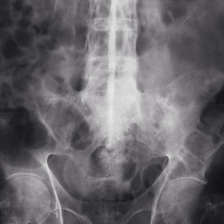 Ankylosing spondylitis | Radiology Reference Article | Radiopaedia.org