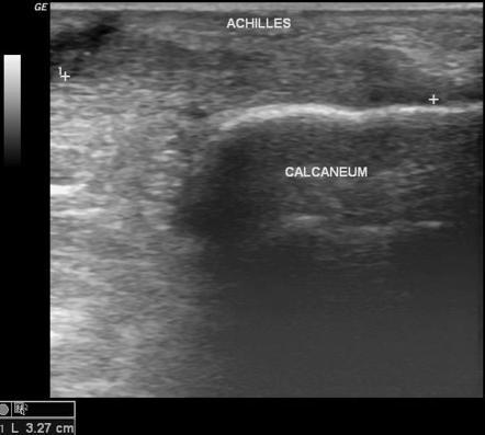 Achilles tendon injury | Radiology Case | Radiopaedia.org