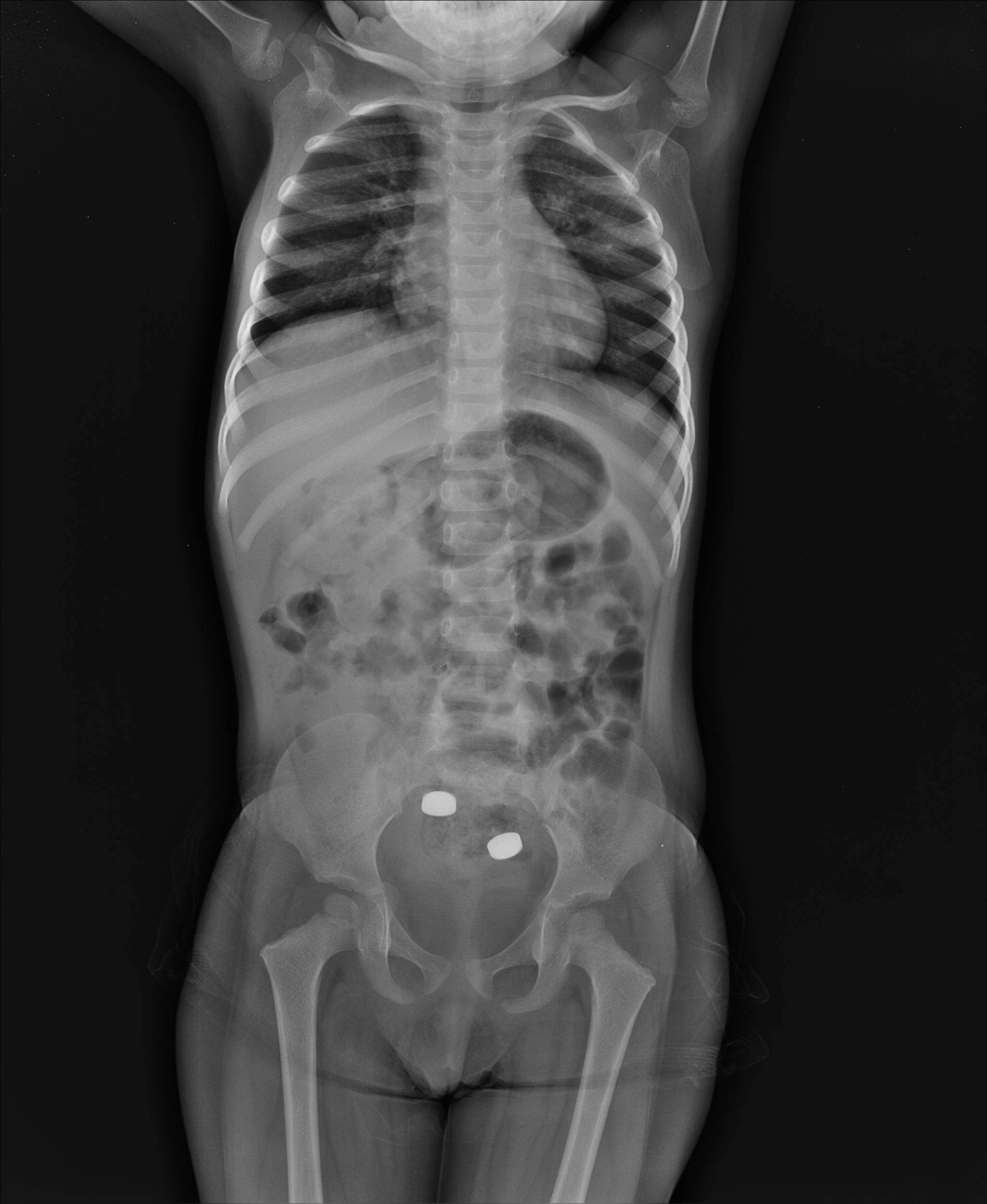 Modality: X-ray (Lateral) .