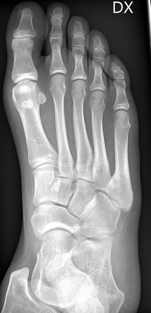 Medial hallux sesamoid fracture | Radiology Case | Radiopaedia.org