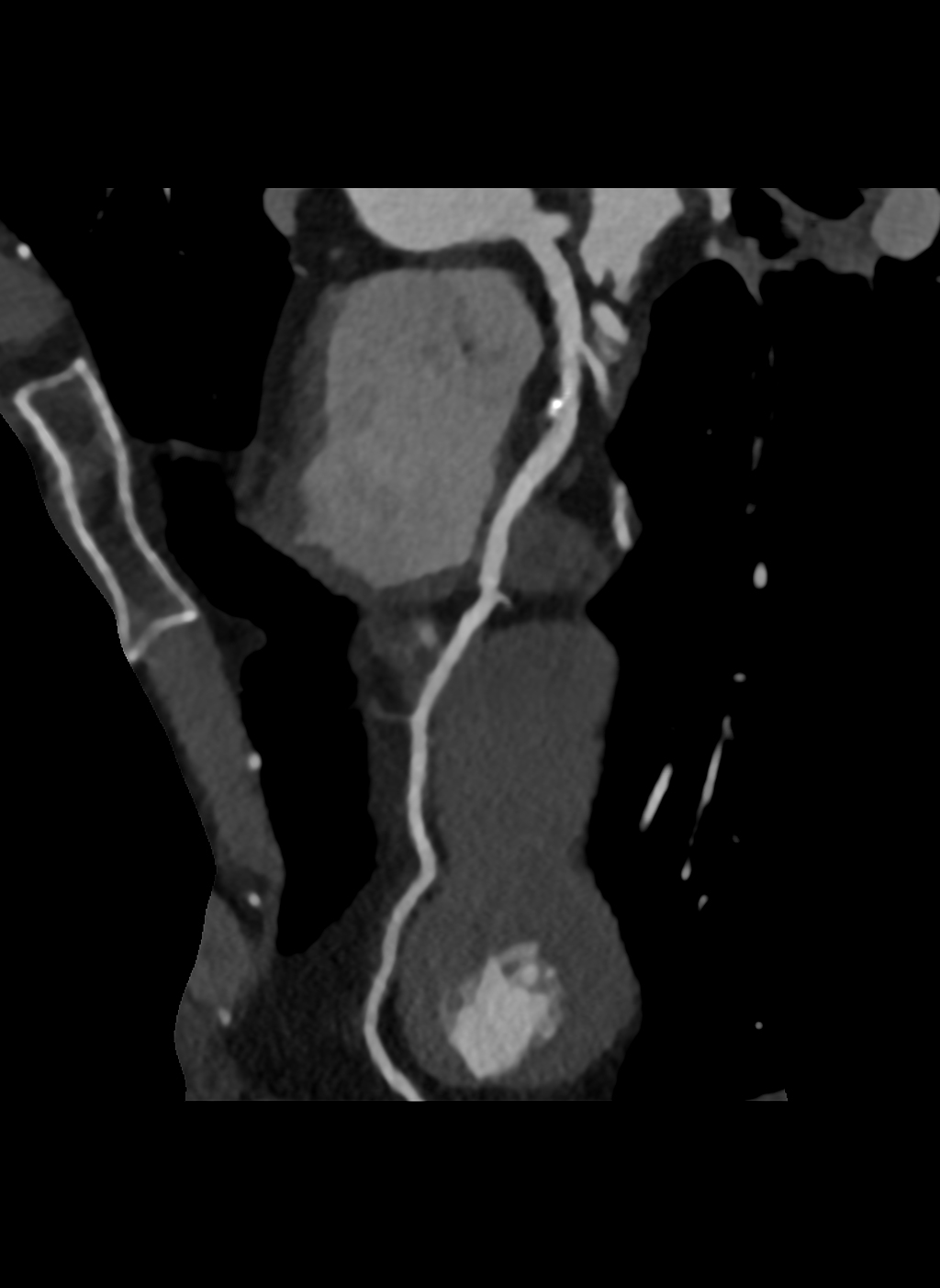 Coronary artery disease | Image | Radiopaedia.org