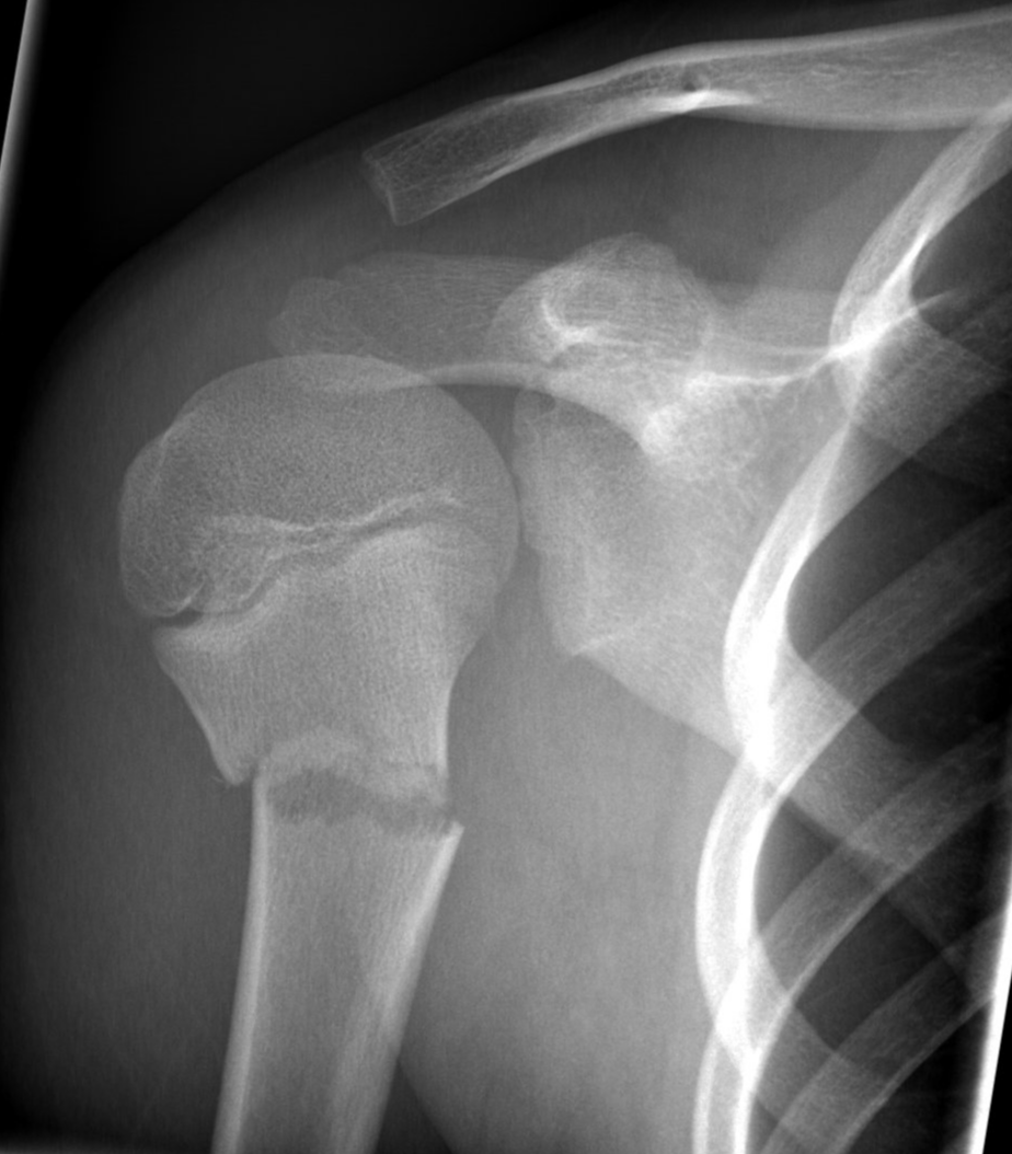 Surgical neck of humerus fracture | Image | Radiopaedia.org