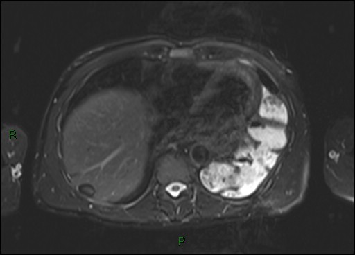 Pseudolipoma of the Glisson capsule | Image | Radiopaedia.org