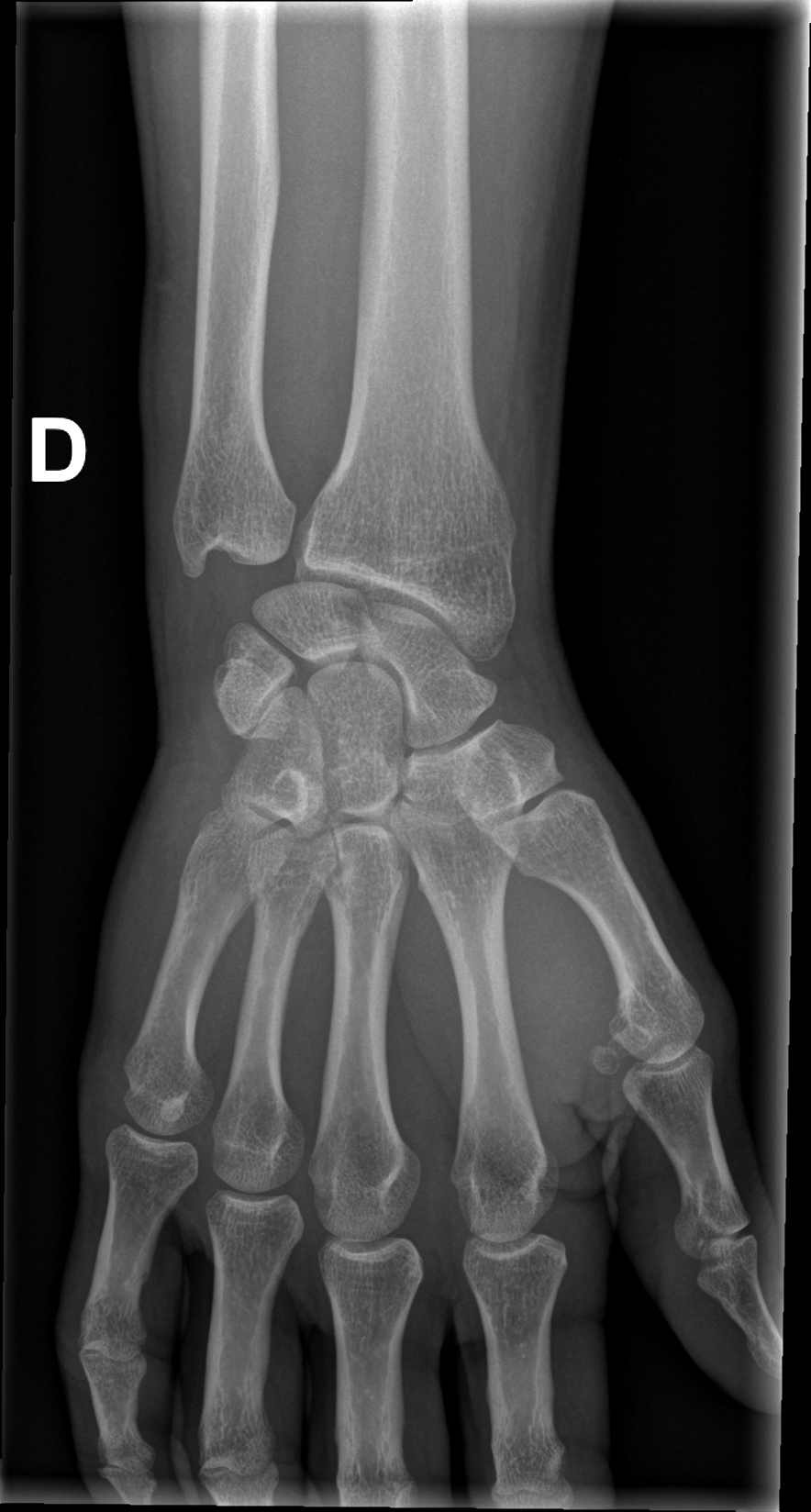 Dorsal Triquetral Avulsion Fracture Image