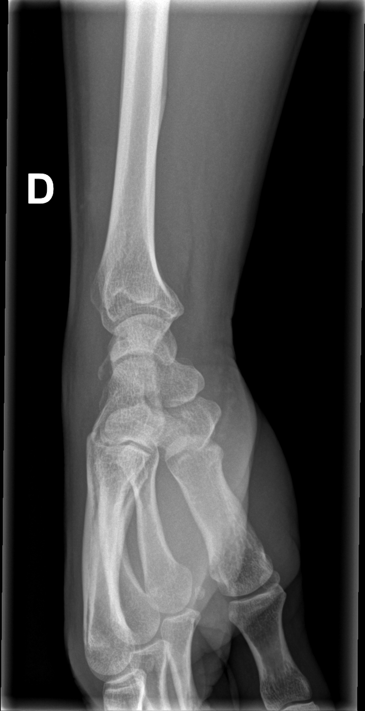 Dorsal Triquetral Avulsion Fracture Image