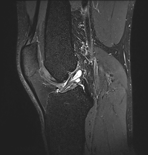 Anterior cruciate ligament ganglion cyst | Image | Radiopaedia.org