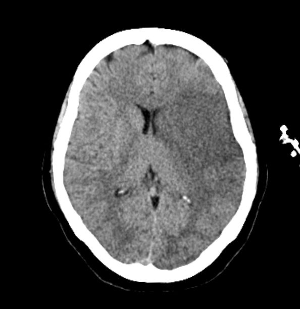 MCA infarct and decompressive craniectomy | Image | Radiopaedia.org