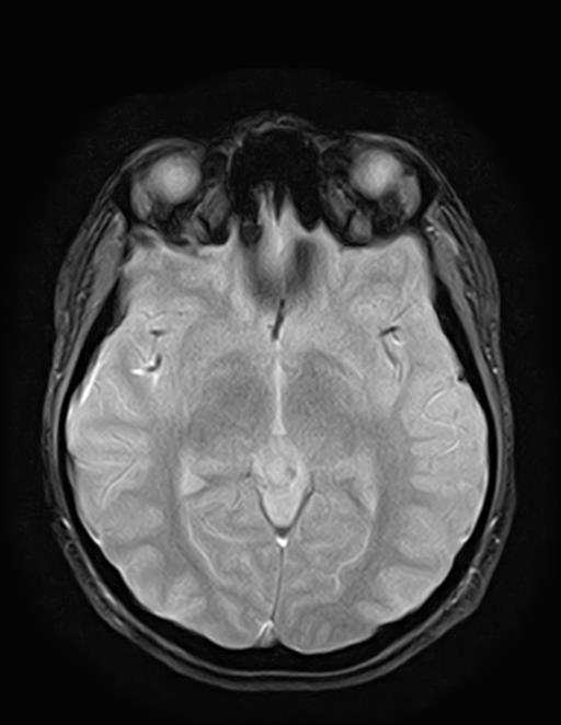 Cerebral venous thrombosis (CVT) | Image | Radiopaedia.org