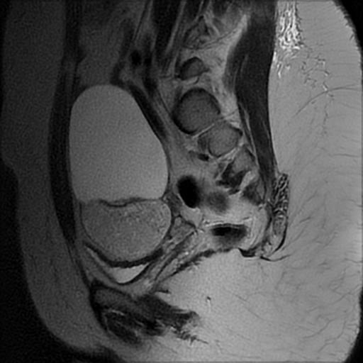 Ovarian dermoid cyst with ipsilaleral unilocular cyst | Image ...