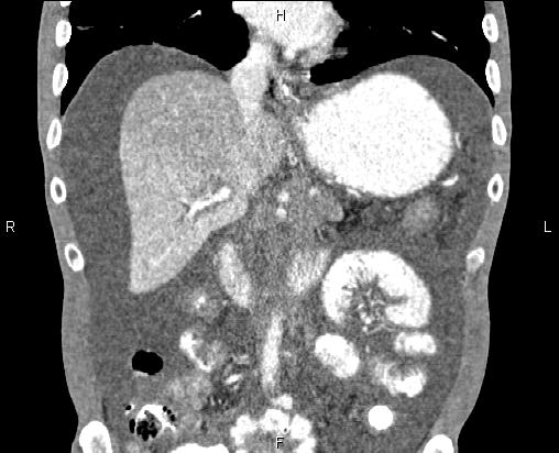 Metastatic Pancreatic Ductal Adenocarcinoma Image