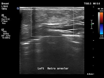 Physiological neonatal breast enlargement Radiology Case