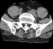 Arachnoiditis ossificans | Radiology Reference Article | Radiopaedia.org