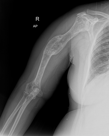 Fracture malunion - humerus | Radiology Case | Radiopaedia.org