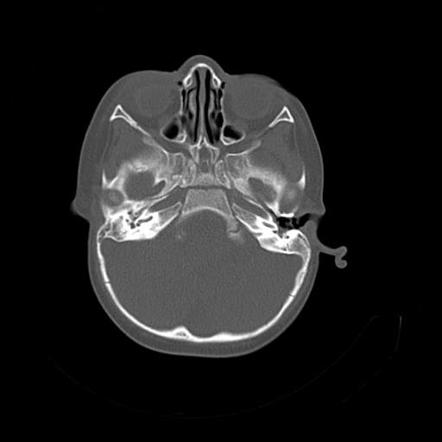 Bony atresia of the right external auditory canal | Image | Radiopaedia.org