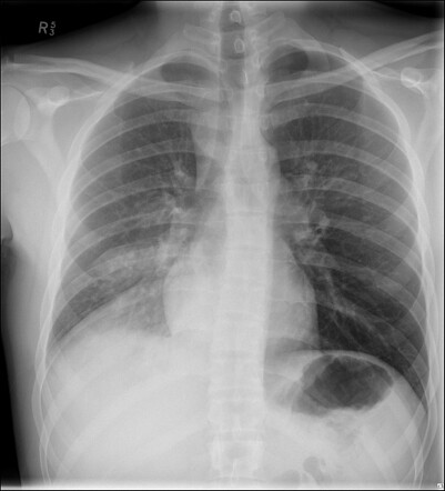 Right lower lobe consolidation | Radiology Case | Radiopaedia.org