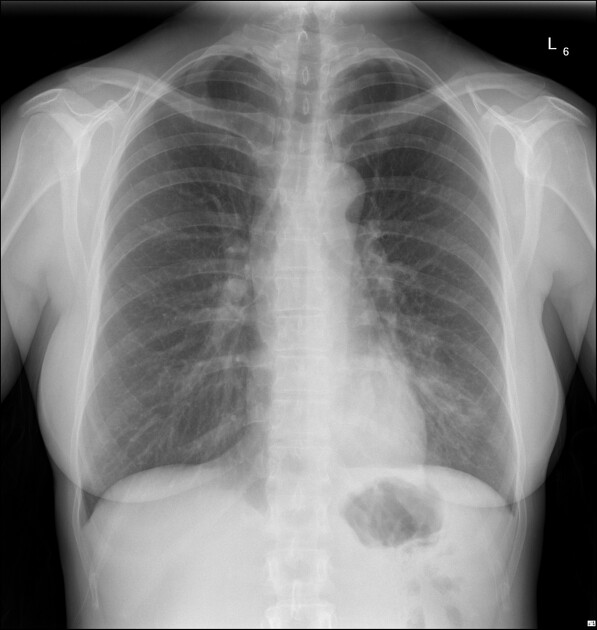 Posterior left lower lobe consolidation Radiology Case